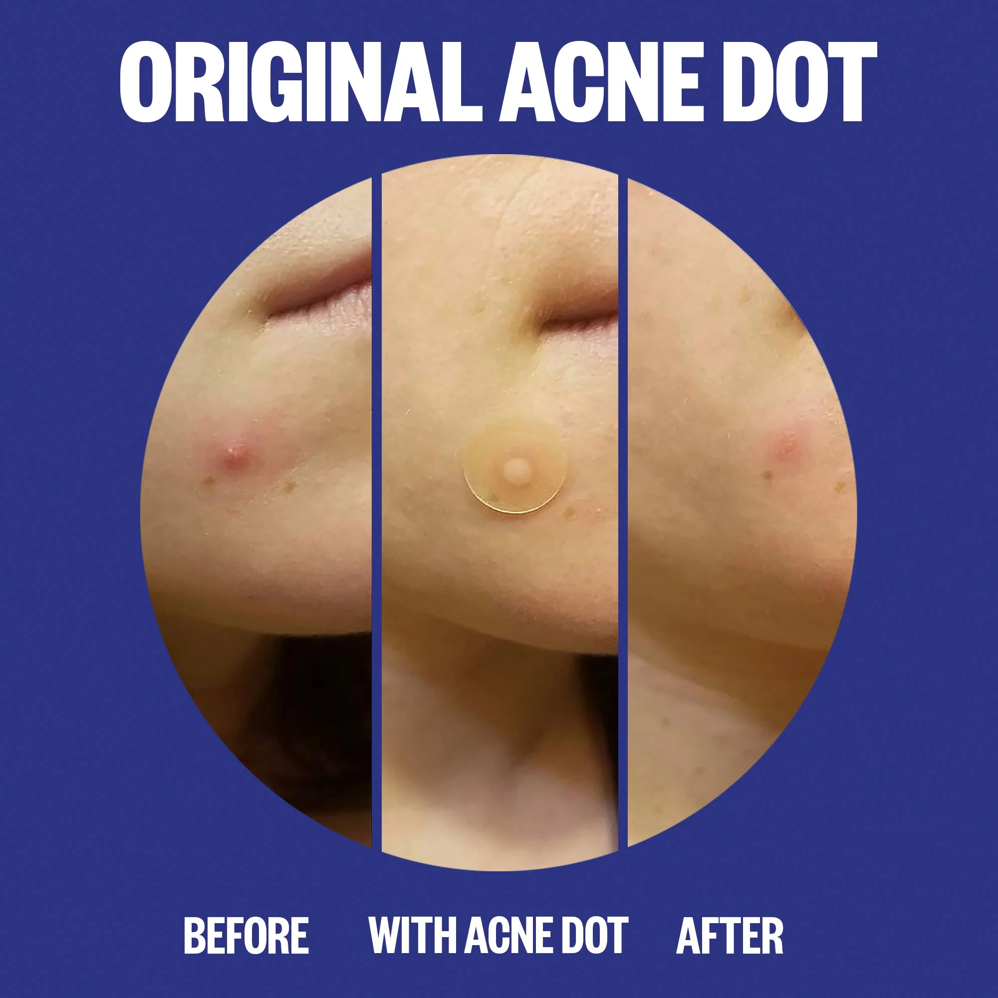 Acne Day & Night Duo (CAN) - Image 4