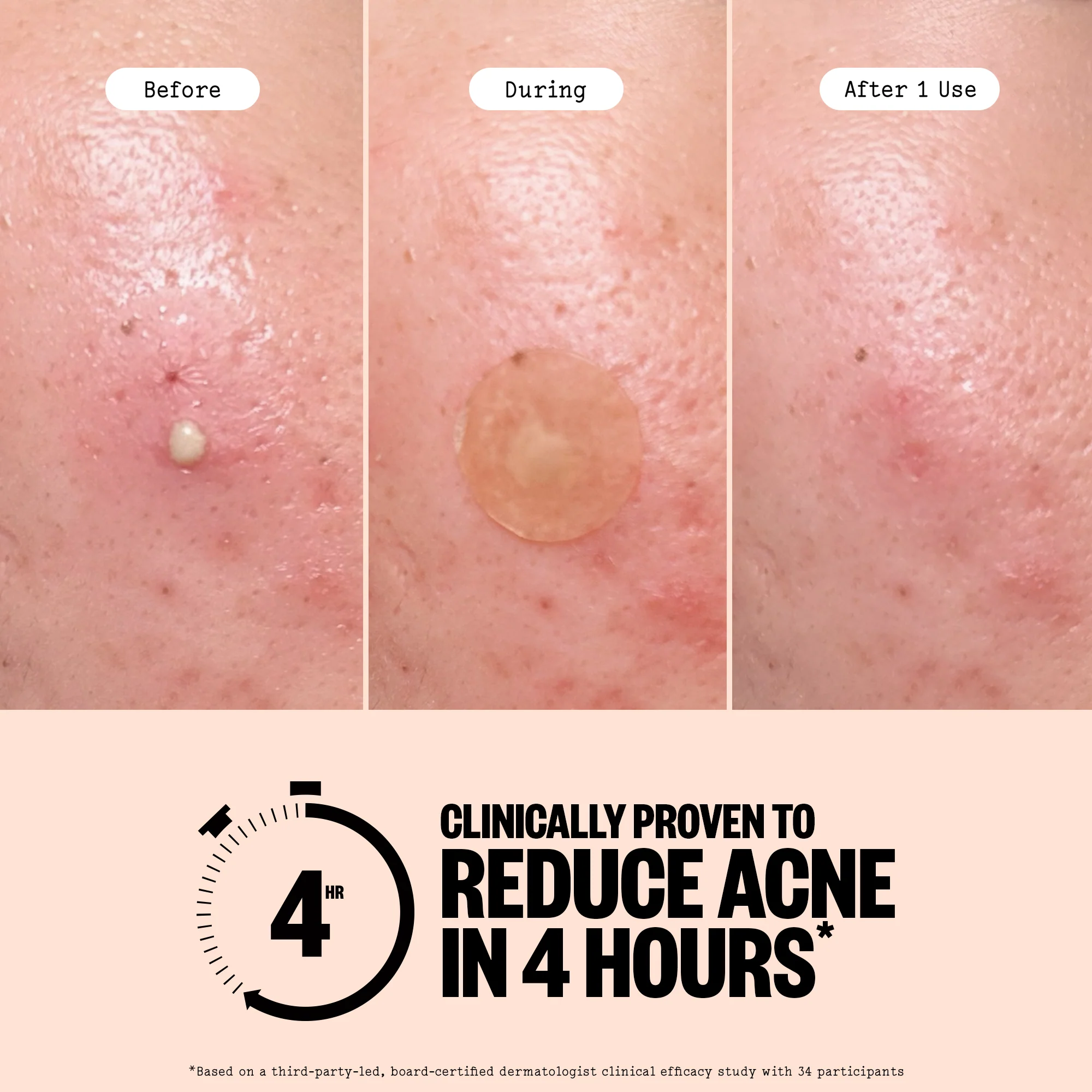 Acne Day & Night Duo - Image 5