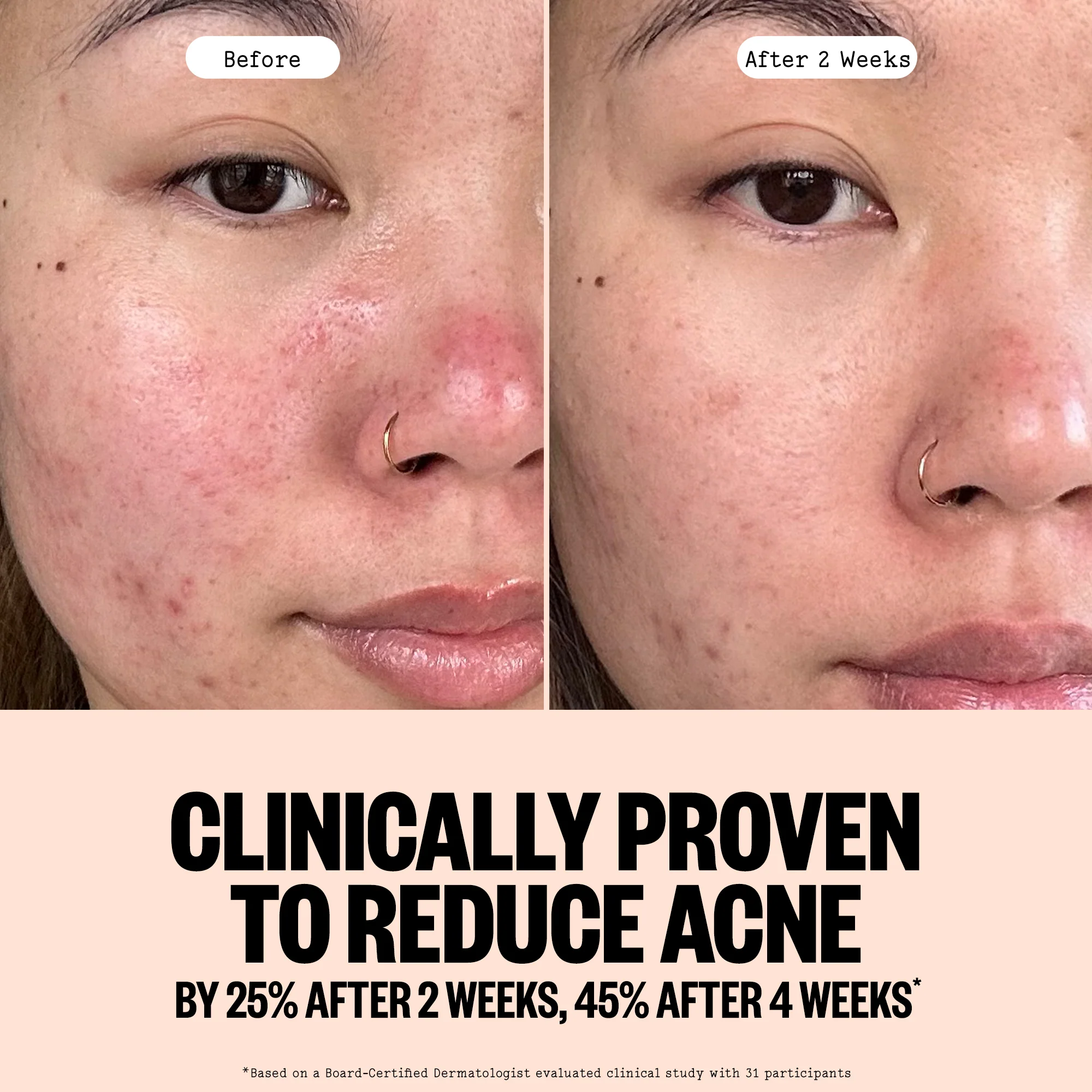 Acne Gel Cleanser - Image 5