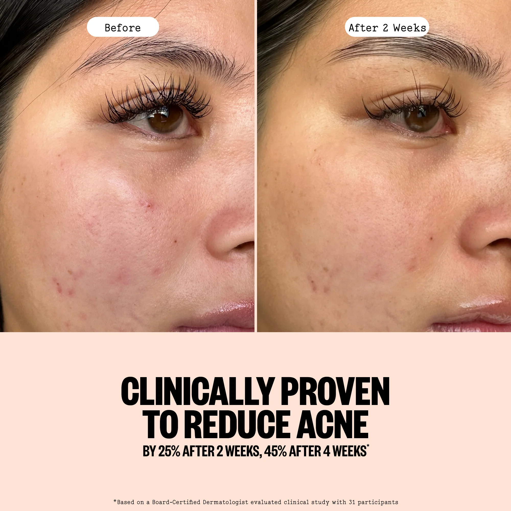 Acne Gel Cleanser - Image 6
