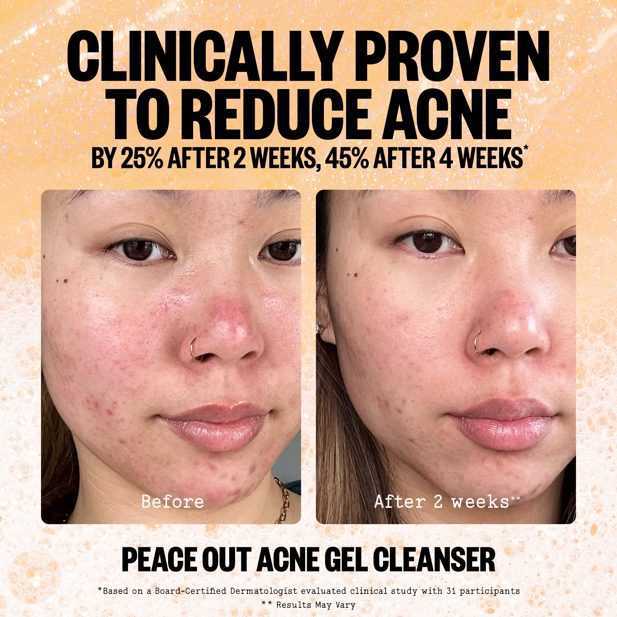 Acne Gel Cleanser (UNI) - Image 6