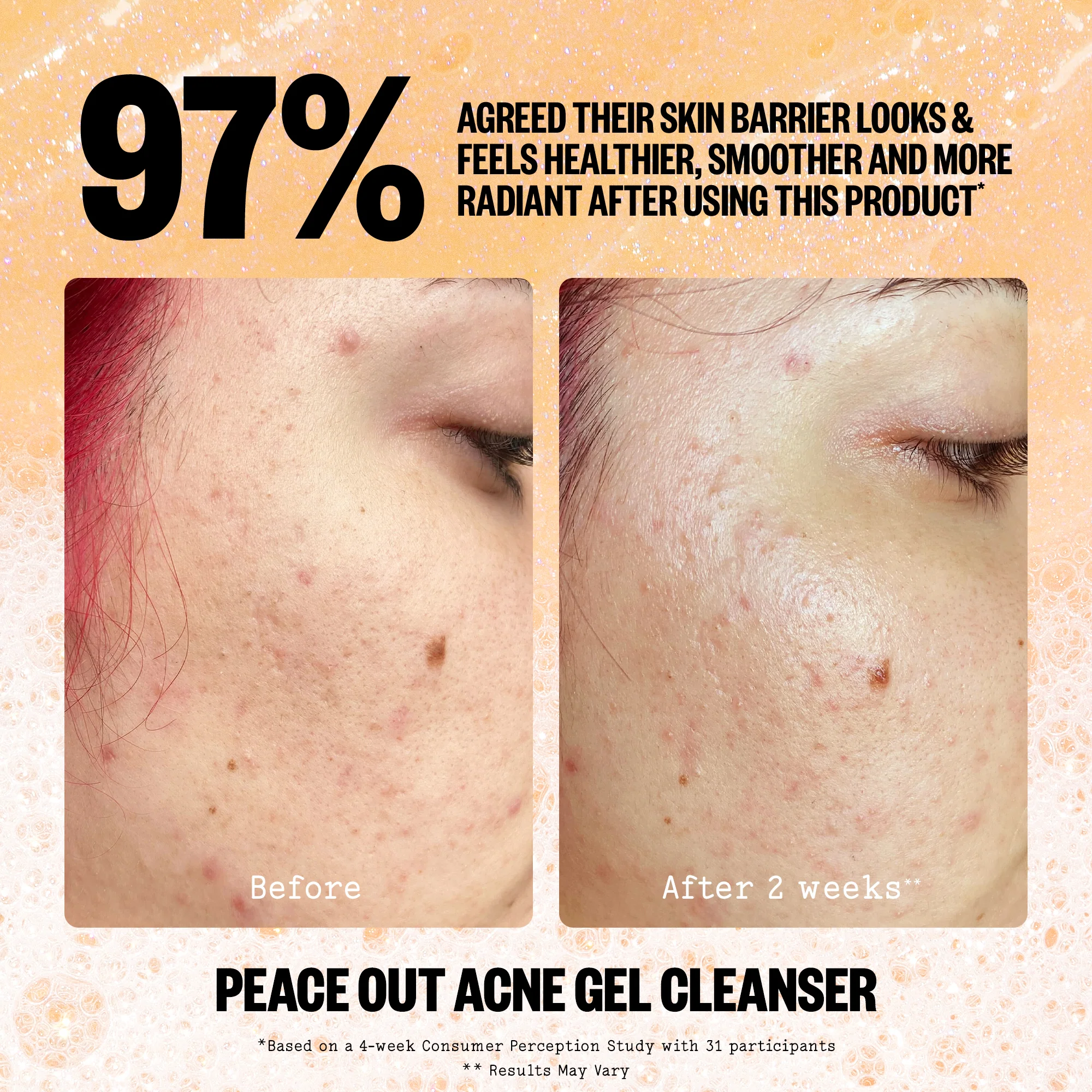 Acne Gel Cleanser (UNI) - Image 9