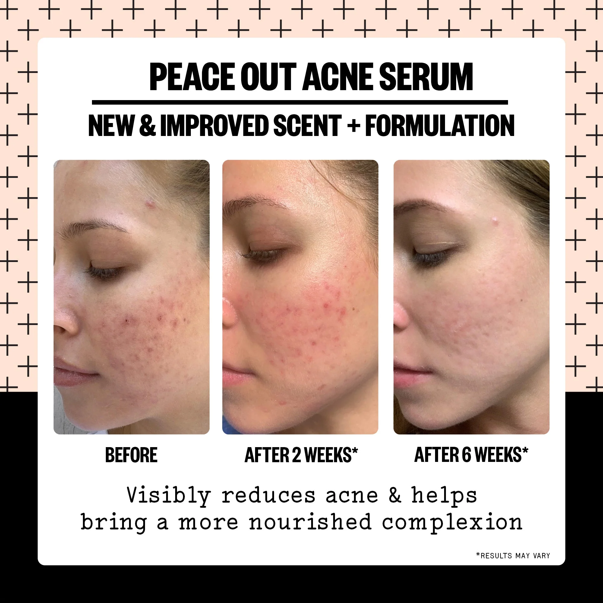 Acne Serum (CAN) - Image 2