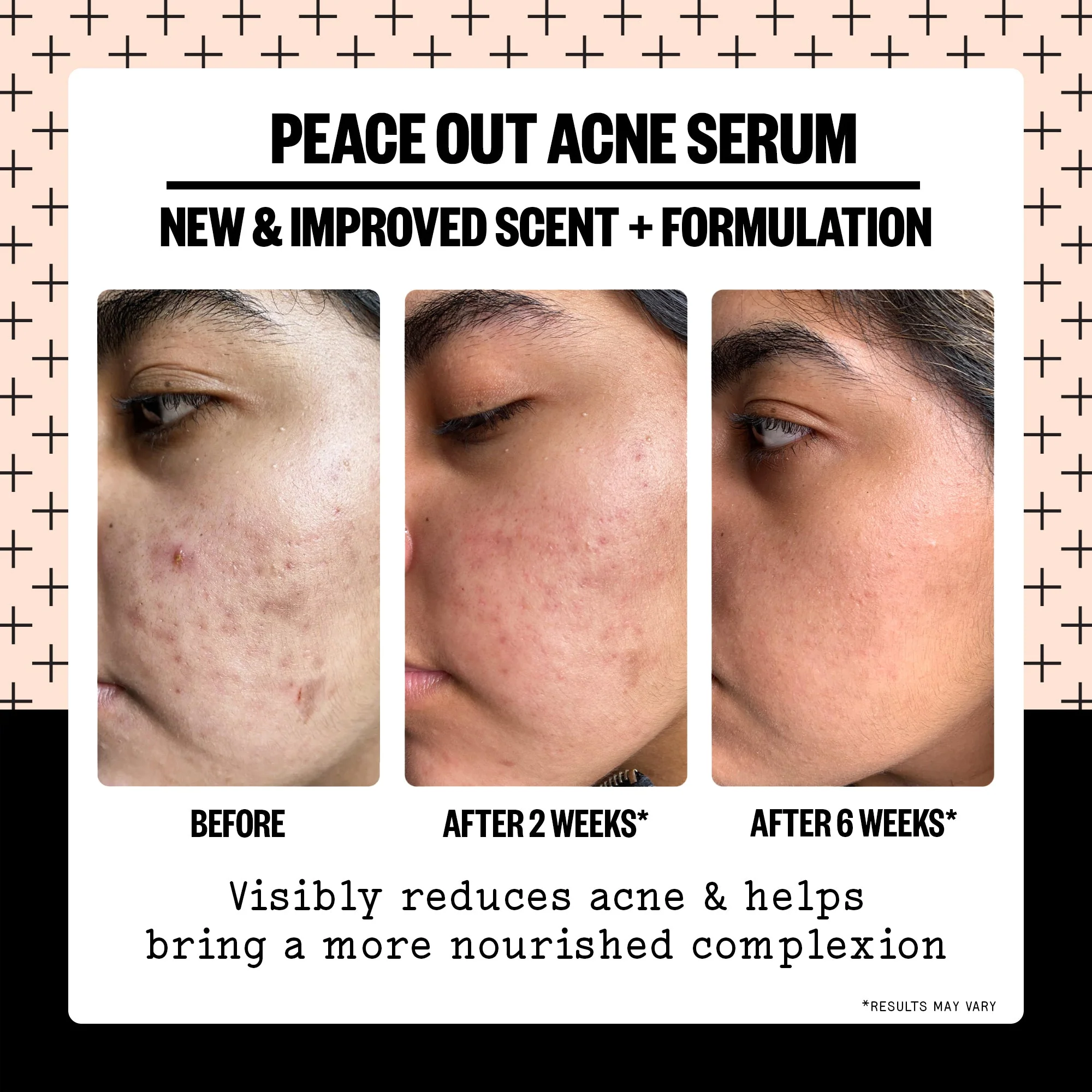 Acne Serum (UNI) - Image 4