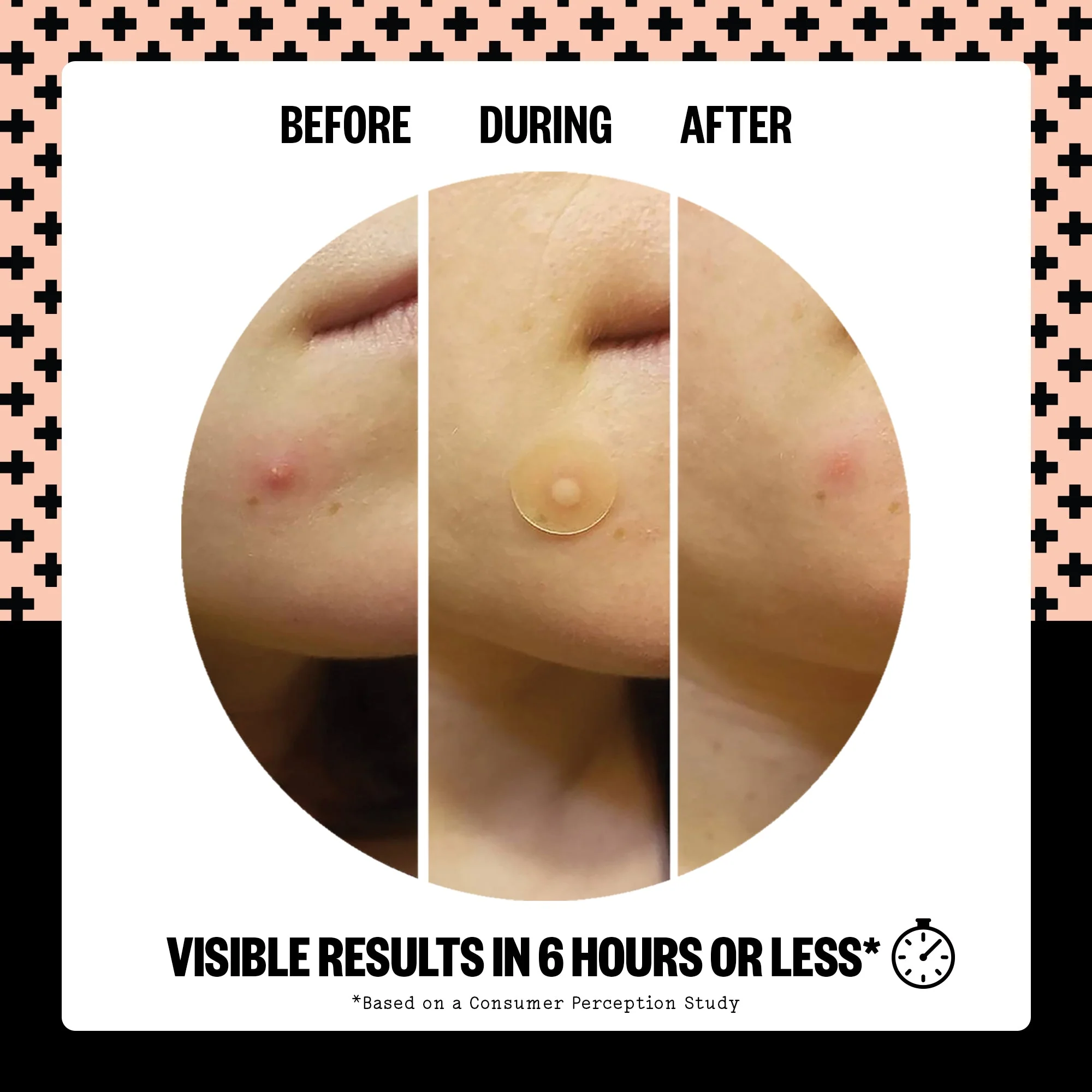 Acne Treatment Dots (CAN) - Image 5