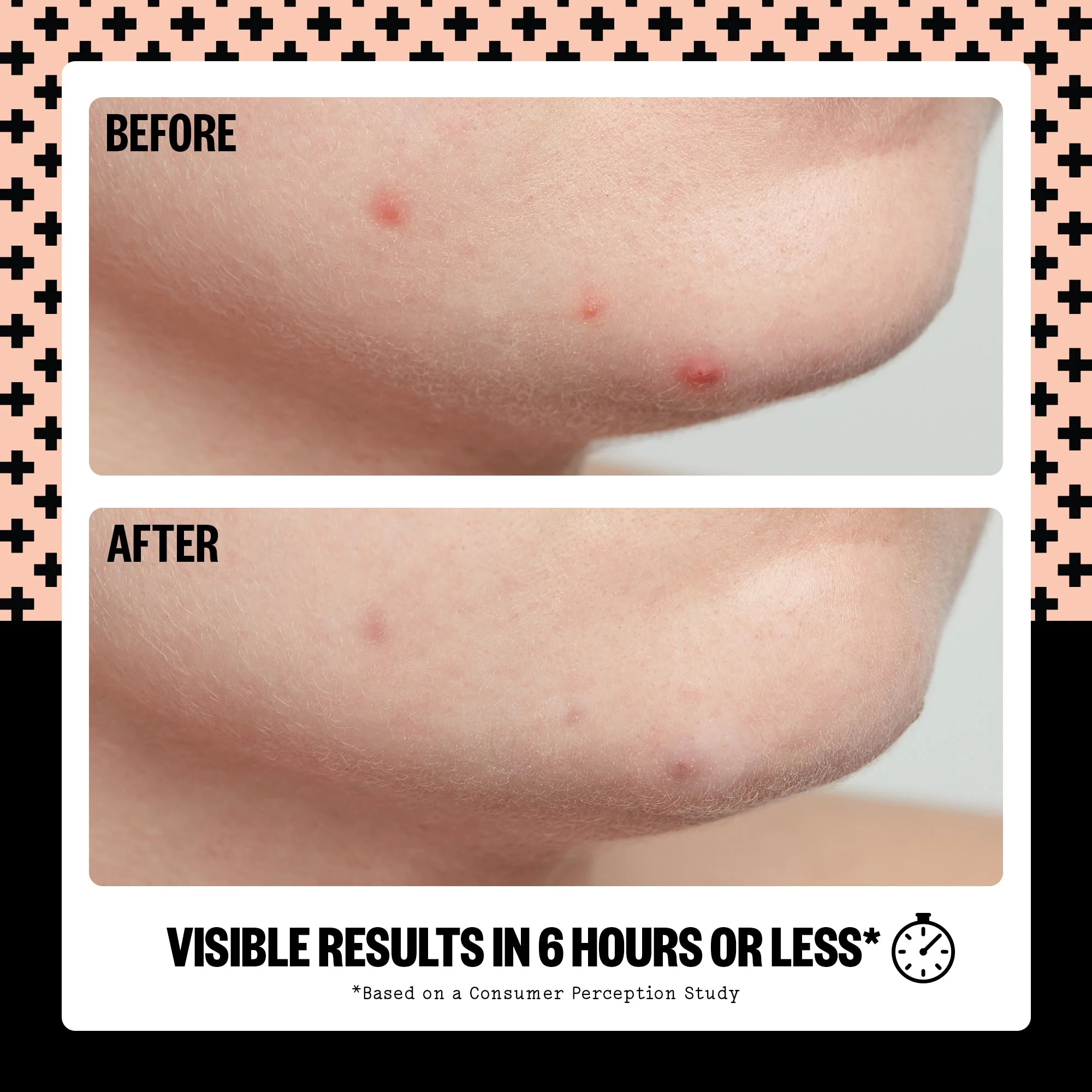 Acne Treatment Dots (CAN) - Image 6