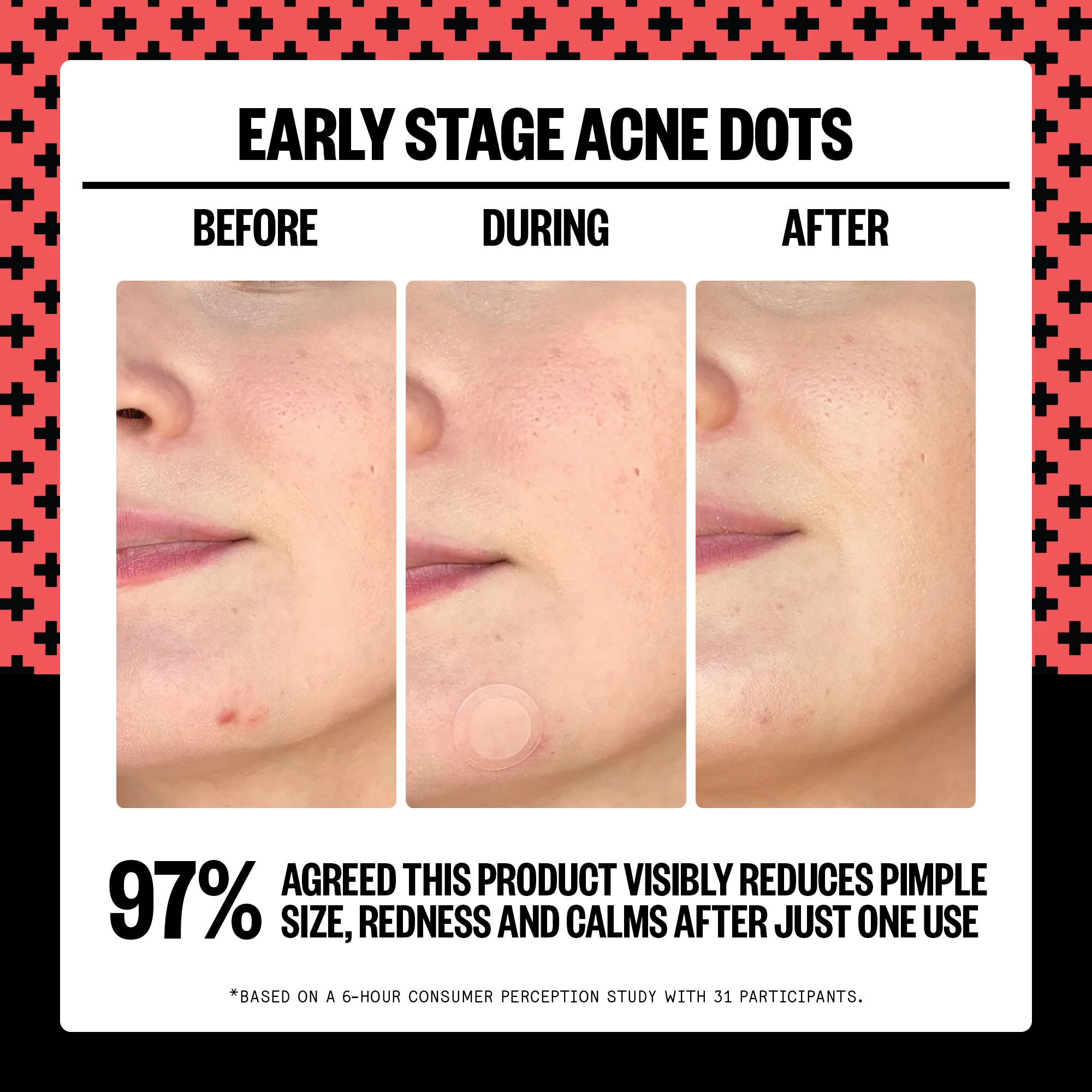 Early Stage Acne Dots - Image 3