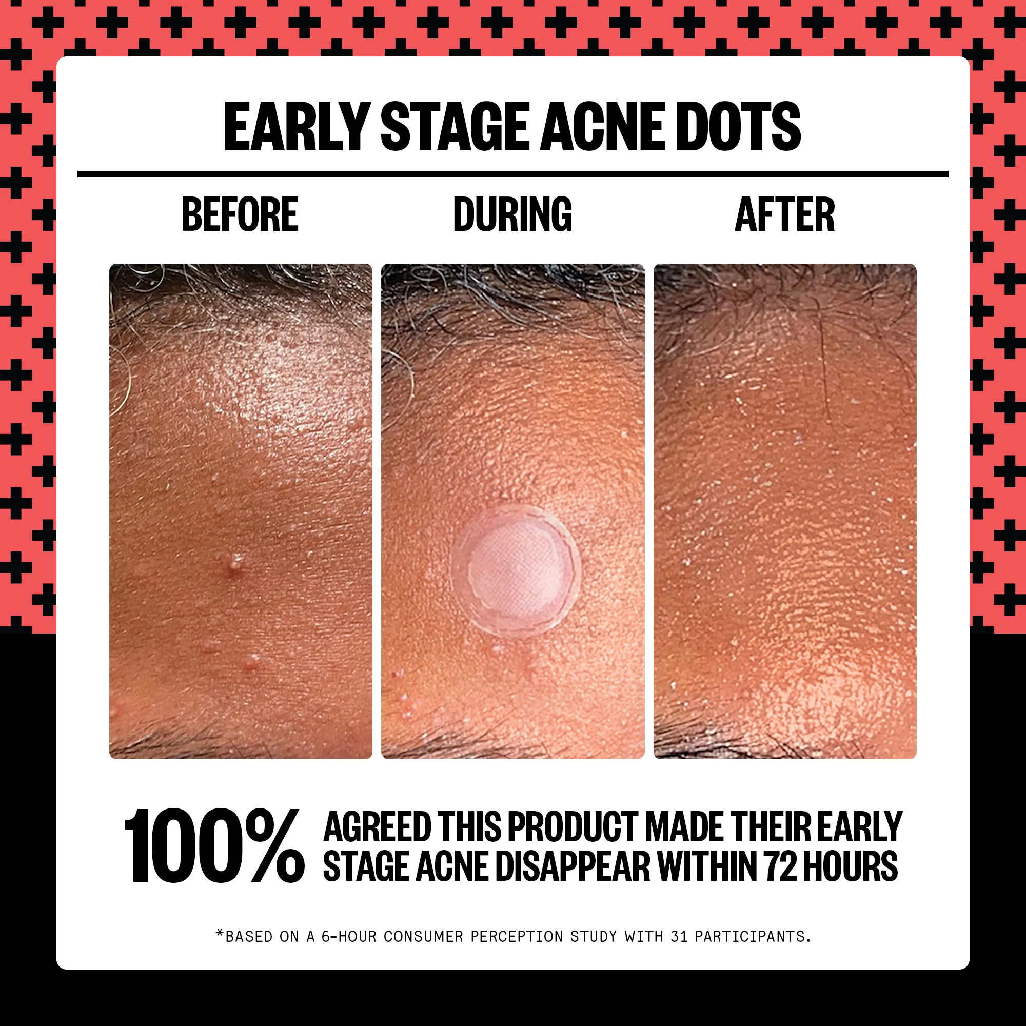 Early Stage Acne Dots - Image 4