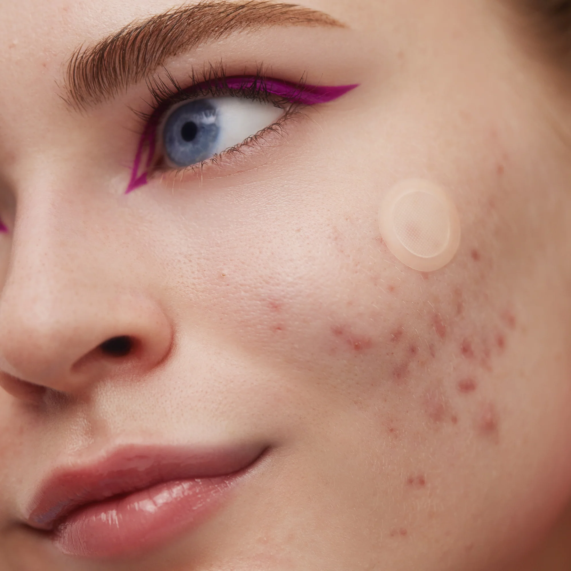 Early Stage Acne Dots - Image 6