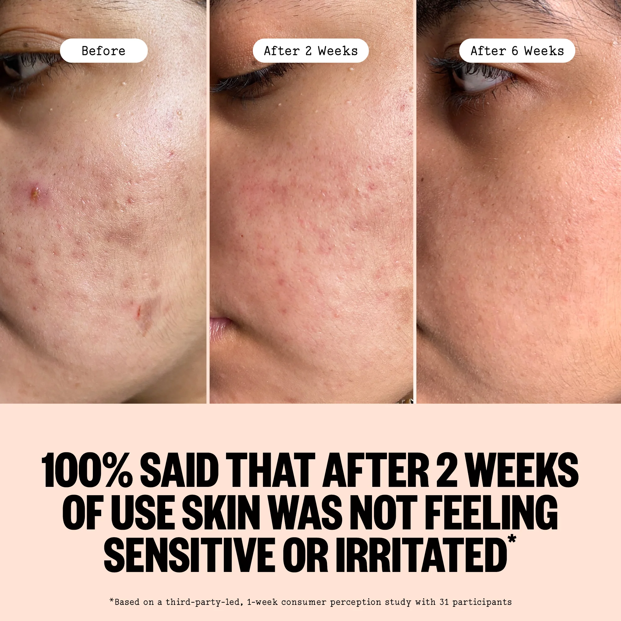 Acne Serum - Image 6