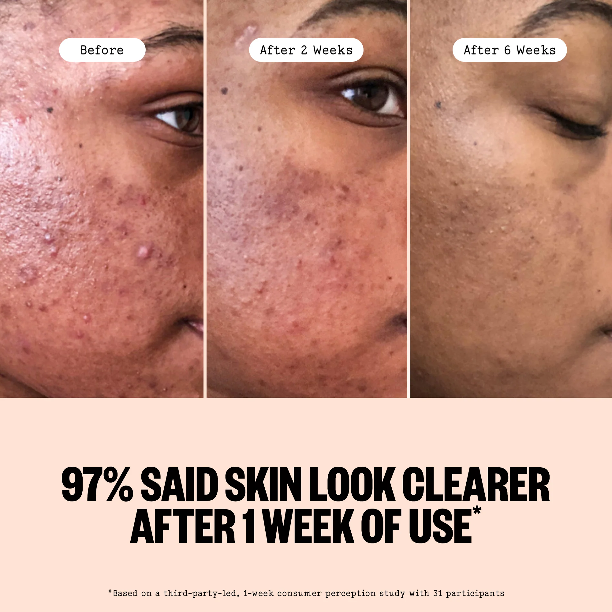 Acne Serum - Image 7