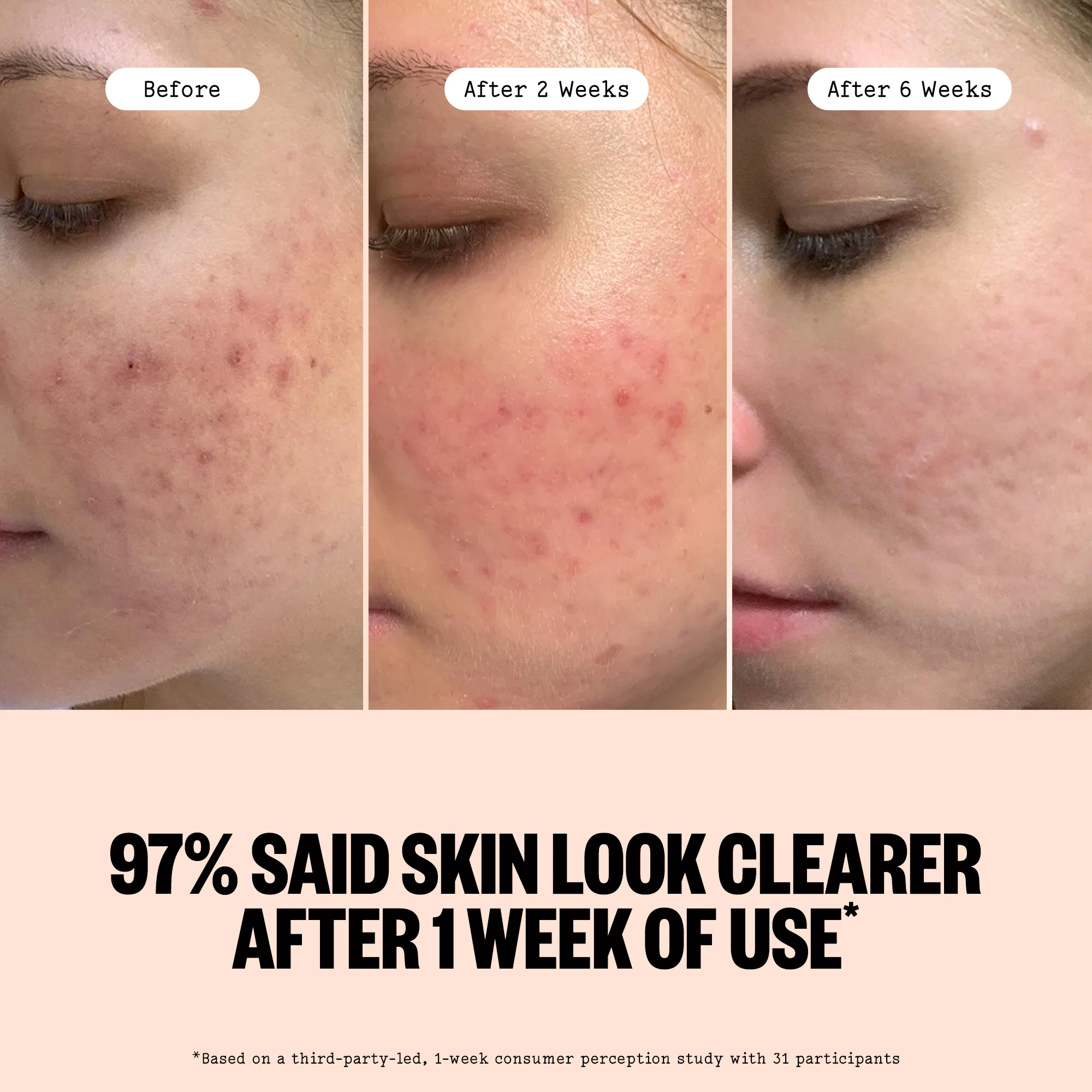 Acne Serum - Image 8