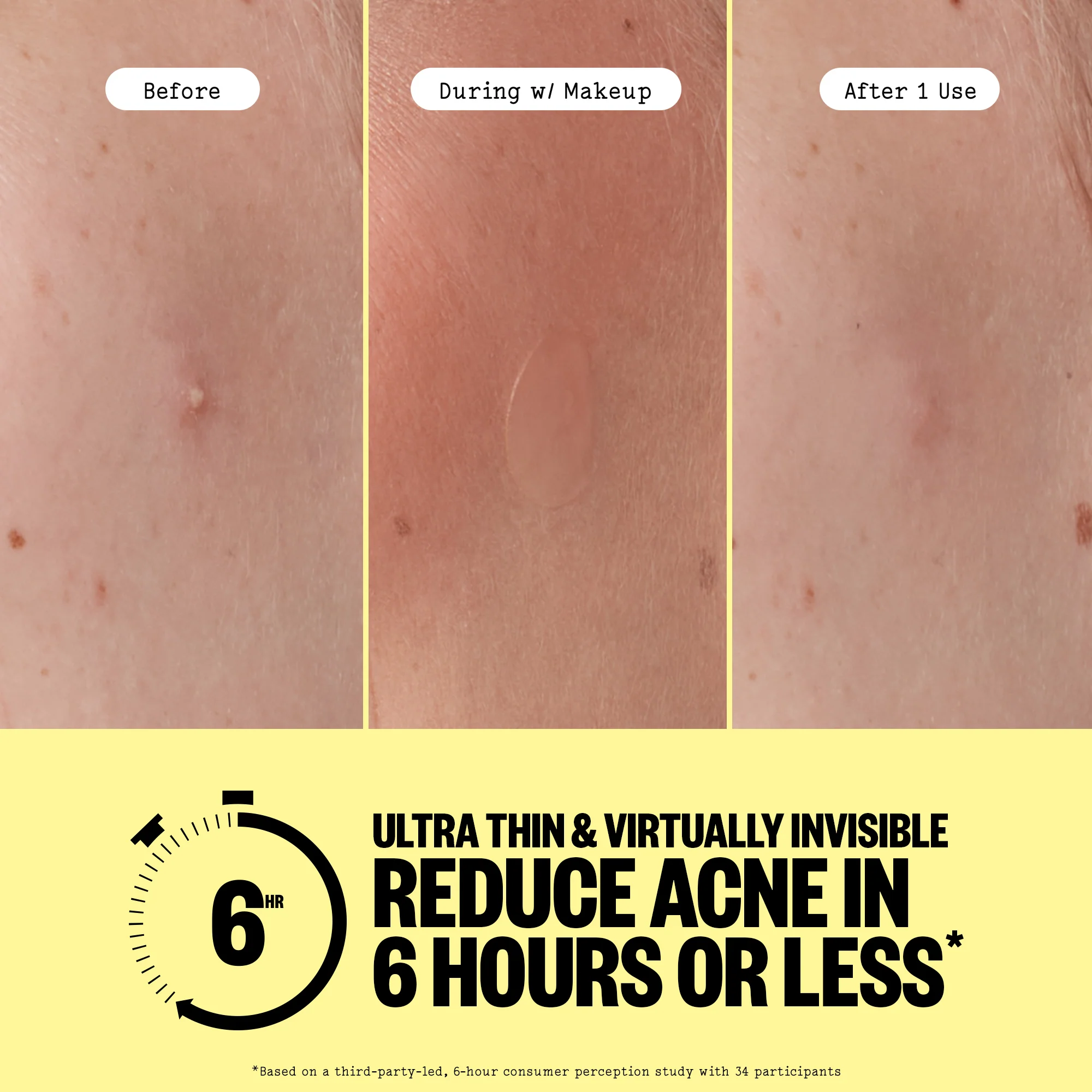 Acne Day Dots - Jumbo - Image 5